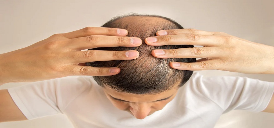 Bahan Alami untuk Menumbuhkan Rambut Supaya Subur