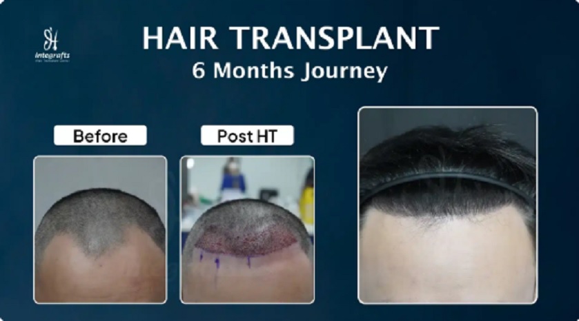 Long hair transplant